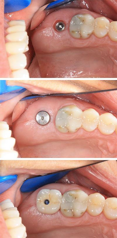 implant-dentaire-saint-etienne