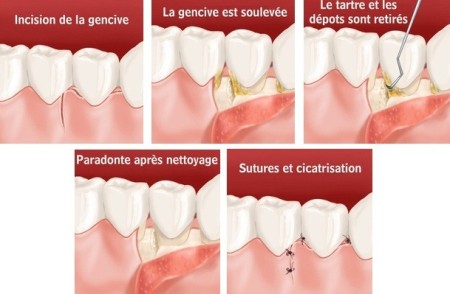 parodontie-saint-etienne