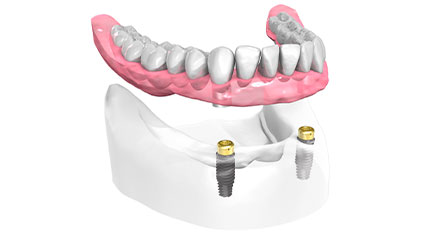 implant-dentaire-saint-etienne