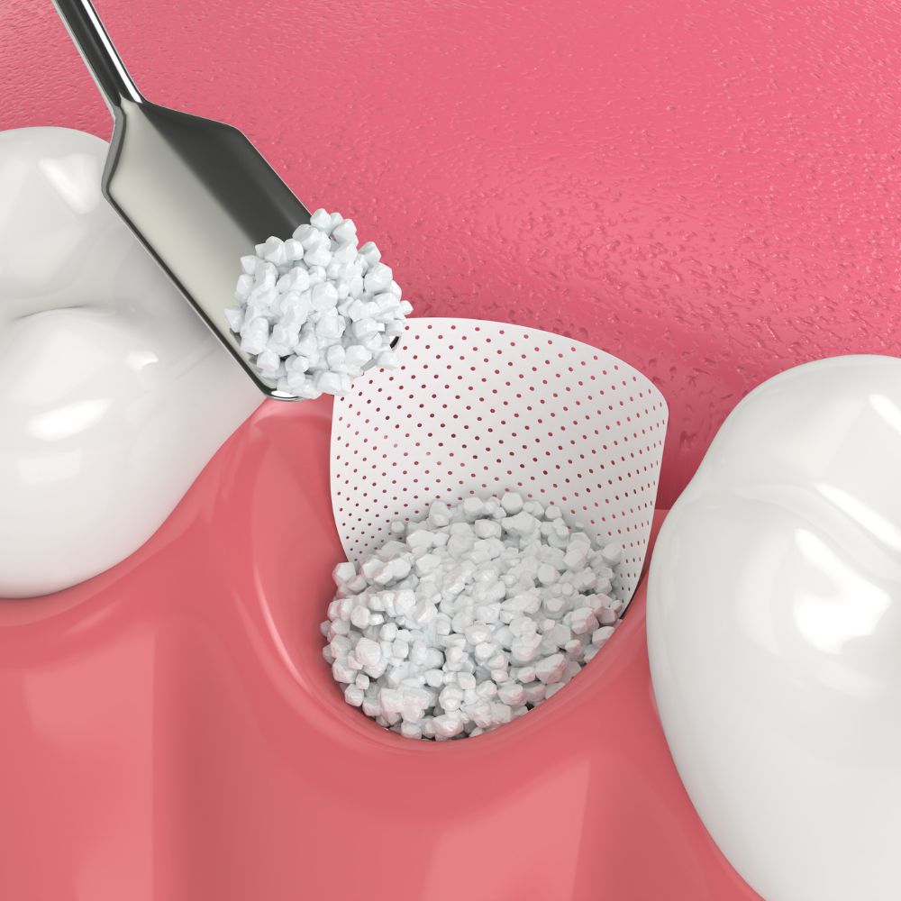 comblement-osseux-dr-raphaelle-contencin-dentiste-saint-etienne