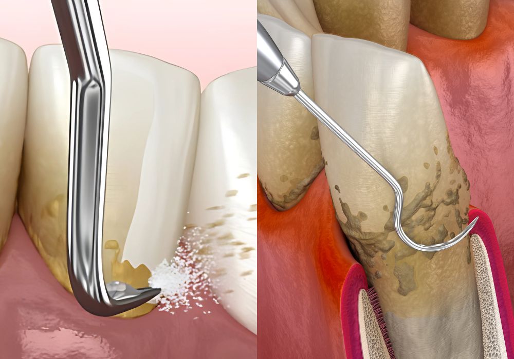 surfacage-radiculaire-dr-raphaelle-contencin-saint-etienne